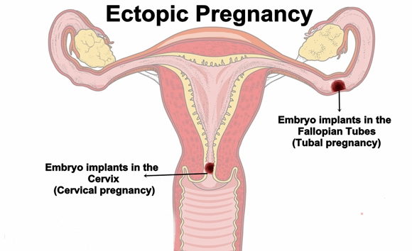 Ectopic-pregnancy