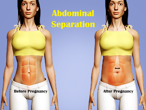 abdominal-separation