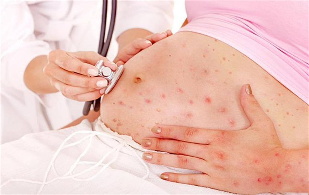 chicken-pox-dangerous-pregnancy