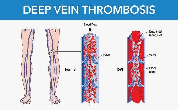 blood clots-dvt-kidborn